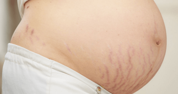 Stretch Marks From Pregnancy