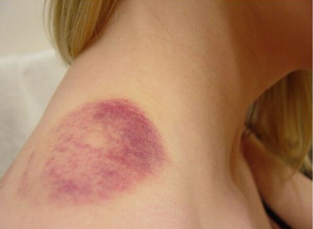 How do you care for a bruise naturally?