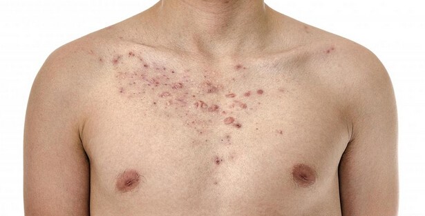 Why Do I Have Acne On My Chest And Back