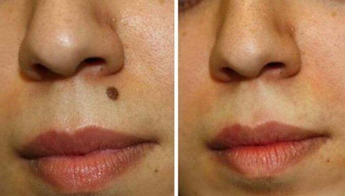 how-to-know-if-your-mole-needs-to-be-looked-at-by-a-doctor-sustain