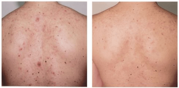 12 Simple Remedies to Get Rid of Back Acne Fast