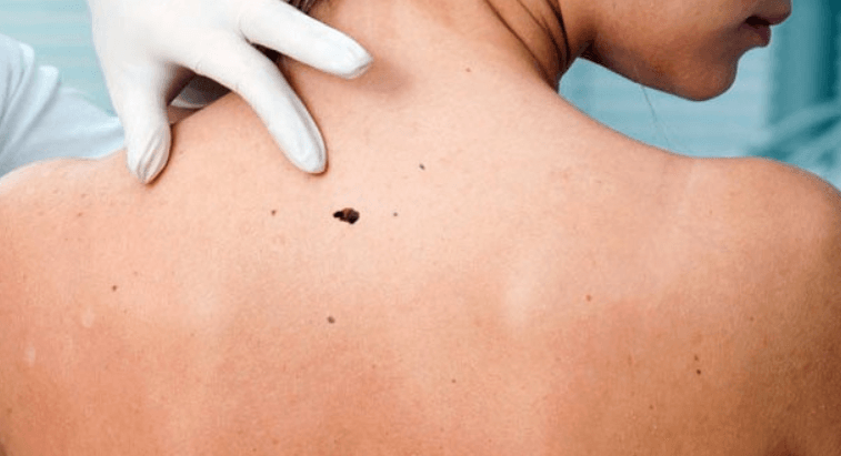 11 Simple Remedies to Get Rid of Back Acne Fast