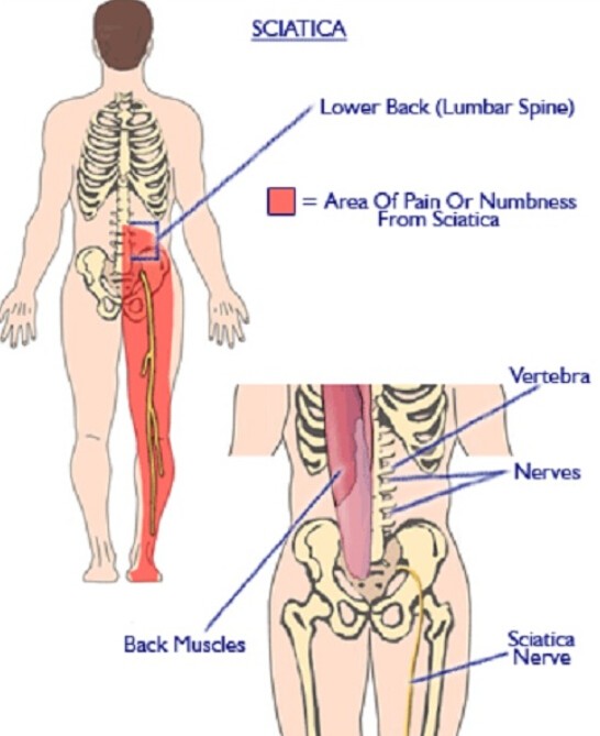 Sciatica anal burning