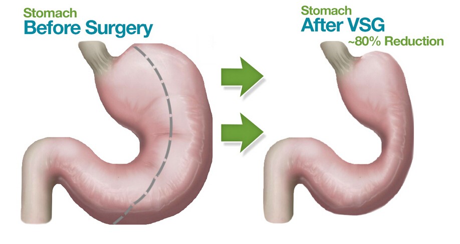 Gastric Sleeve Diet Plan Before Surgery