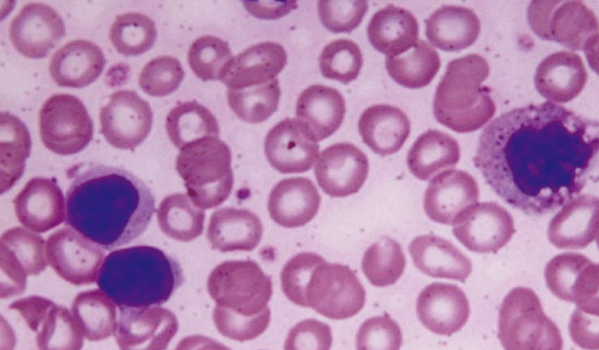 high-neutrophil-to-lymphocyte-ratio-as-a-prognostic-marker-in-covid-19