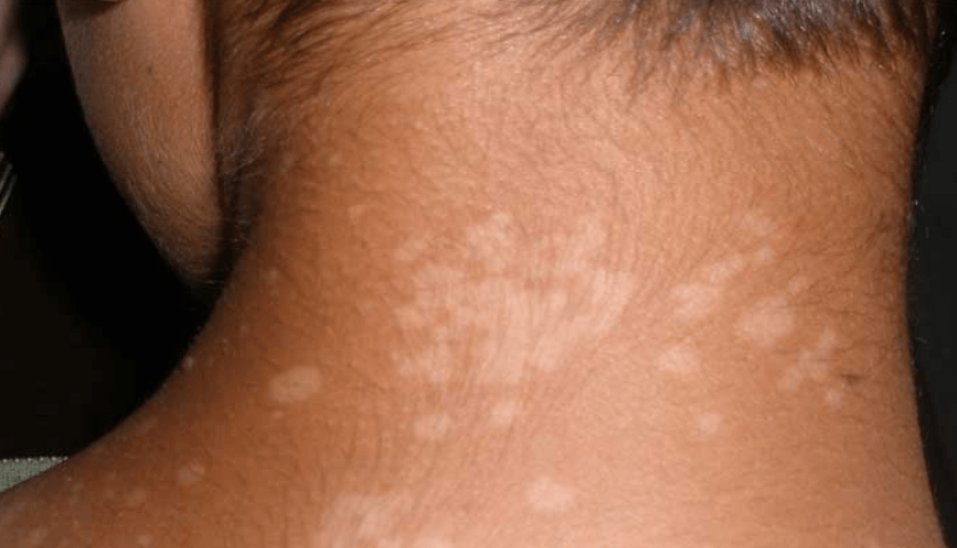 How To Get Rid Of Sunspots On Skin Naturally