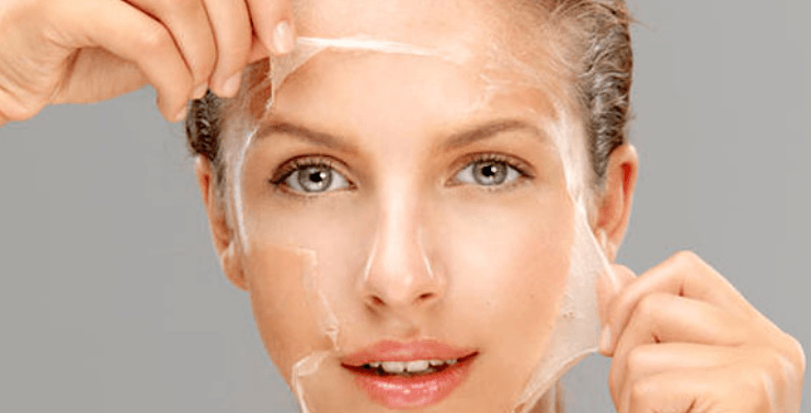 Chemical Peel