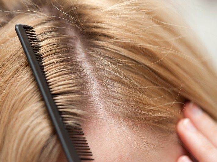 21 Natural Remedies to Get Rid of Dandruff Fast