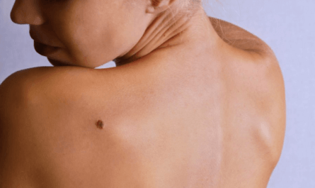 How to Remove Skin Tags By Yourself at Home