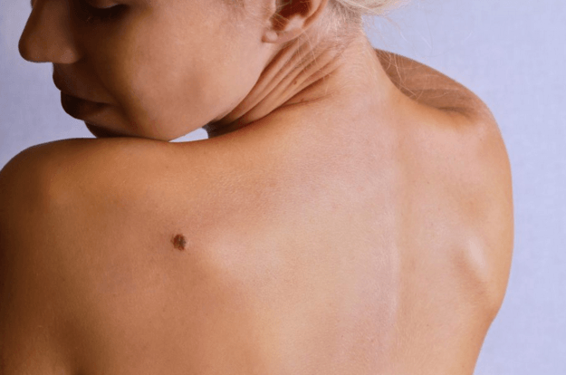 16 Natural Remedies to Get Rid of Skin Tags