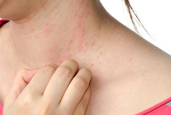 How to get rid of hives