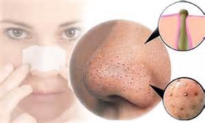 Get Rid of Whiteheads On Nose