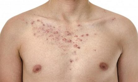 Get Rid of Chest Acne