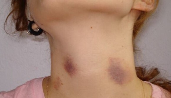 comment se debarrasser d un hickey de nuit rapide e beaute sante