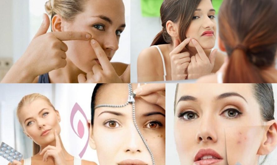 15 Natural Remedies to Get Rid of Pimples Overnight Fast