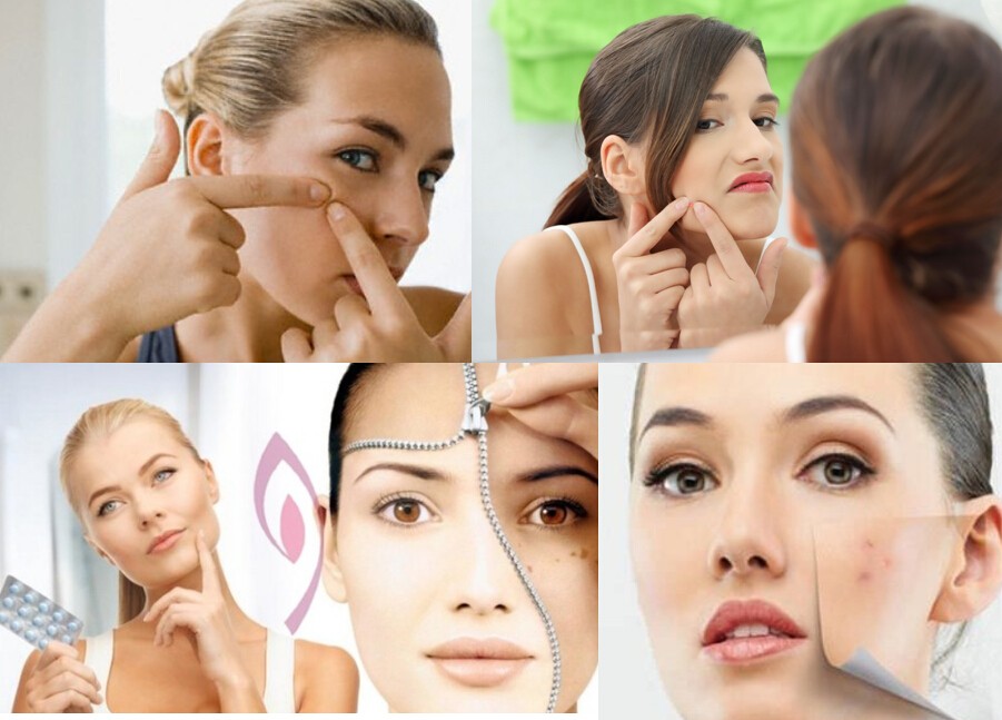 15 Natural Remedies to Get Rid of Pimples Overnight Fast