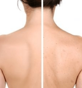 How to Get Rid of Back Acne:15 Best Remedies