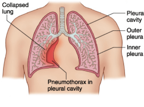 Collapsed lung