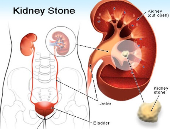 Kidney Stones