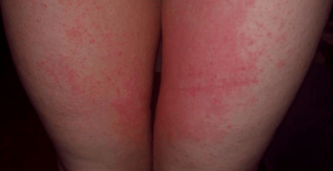 Rash on Inner Thigh Causes and Treatment