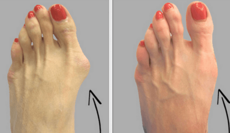 4 Easy Ways to Get Rid of Bunions Fast and Naturally