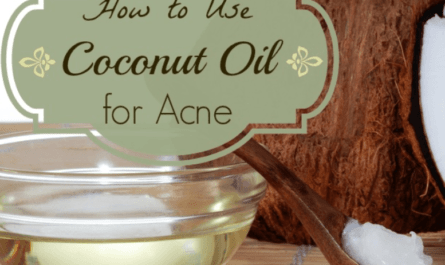 Coconut Oil for Acne