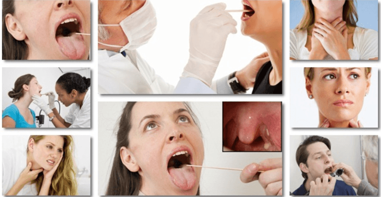 15 Natural Ways to Get Rid of Tonsil Stones Permanently