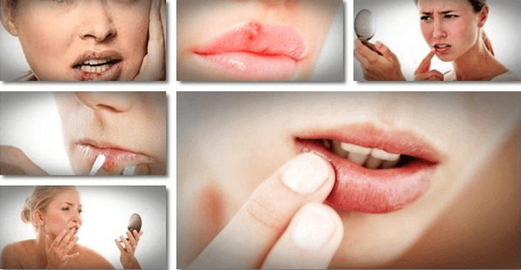 Get Rid of Cold Sore