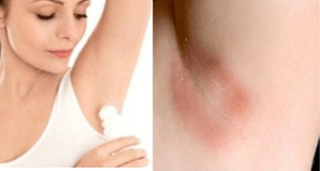 Get Rid of Armpit Rash