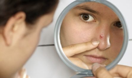 Get Rid of Pimple in Nose