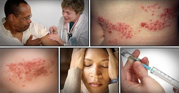 How to Get Rid of Shingles Fast and Naturally