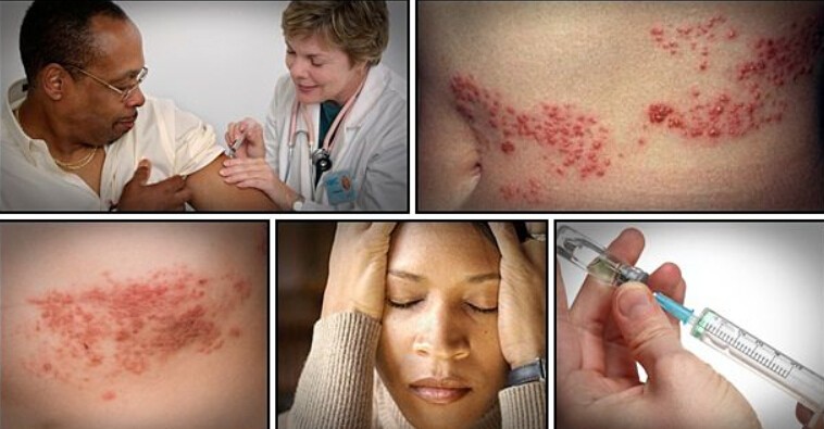 Get Rid of Shingles Fast