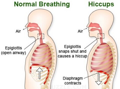 Common Causes of Hiccups