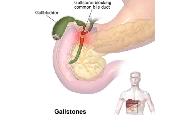 Gallstones