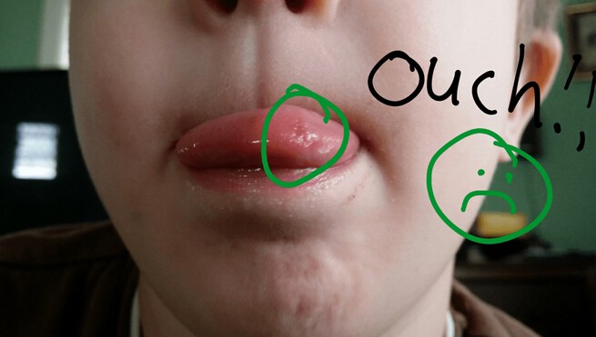 Get Rid of Canker Sores on Tongue