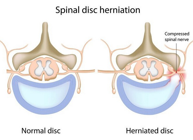 Herniated Disk