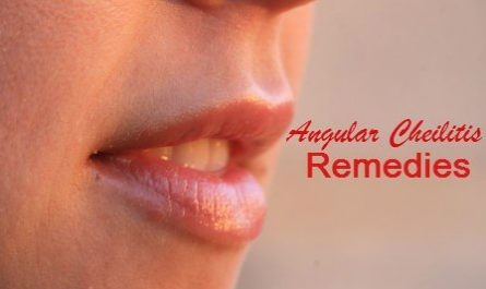 Natural Treatments for Angular Cheilitis