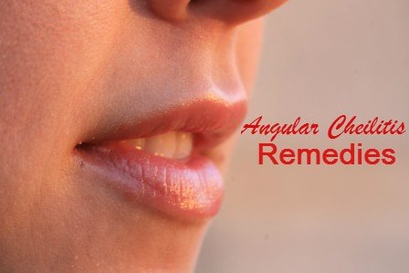 12 Natural Treatments for Angular Cheilitis