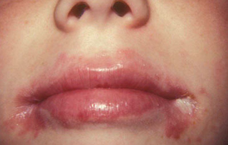 Symptoms of Angular Cheilitis