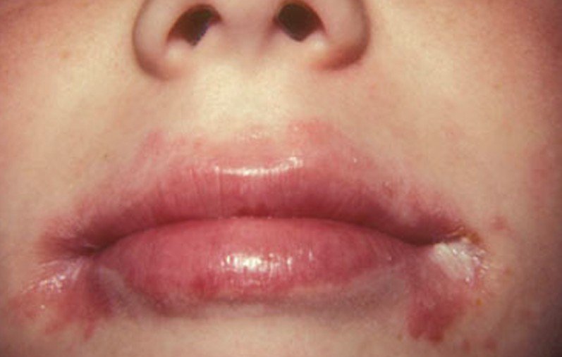 mouth lip problem Treatments Natural for Cheilitis Angular 12