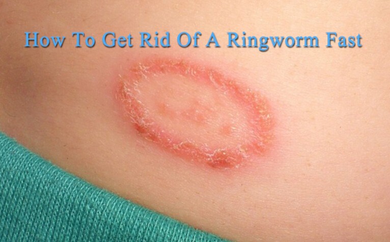 what is ringworm