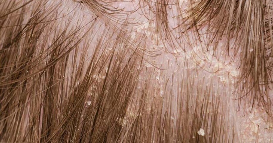 Dandruff Vs Dry Scalp - What’s the Difference?