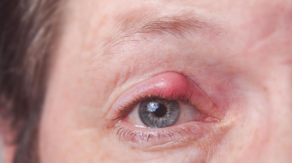 warm eye compress for chalazion