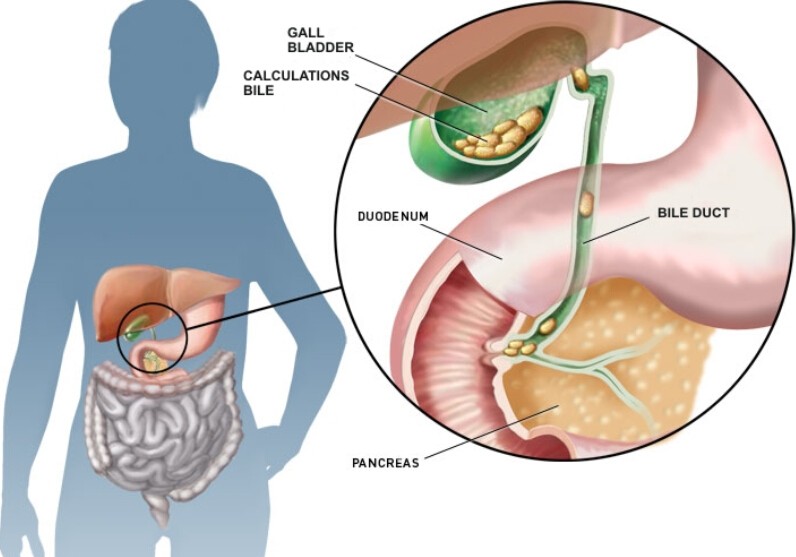 Gallbladder Stones