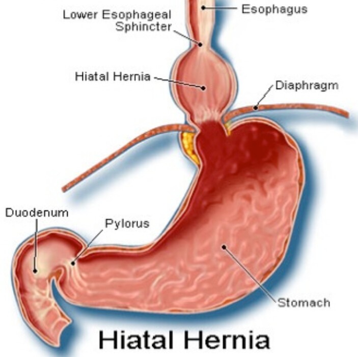 Hiatal Hernia