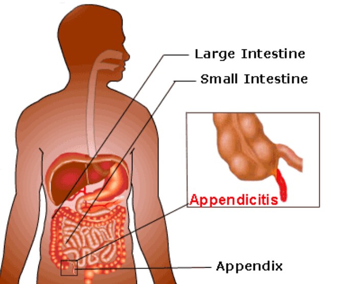 Appendicitis