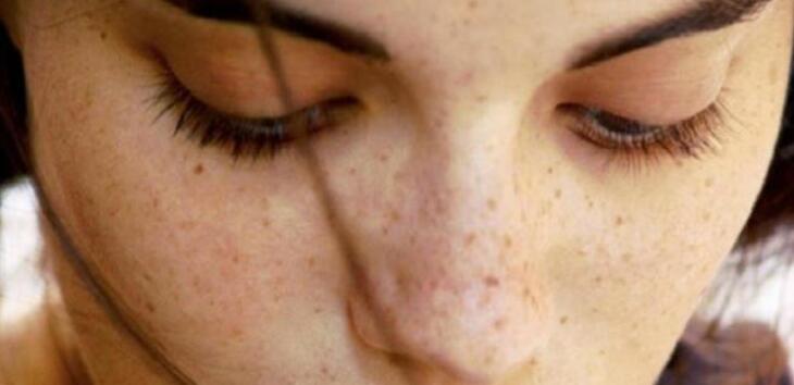Home Remedies to Get Rid of Brown Spots