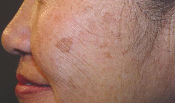 age spots on face