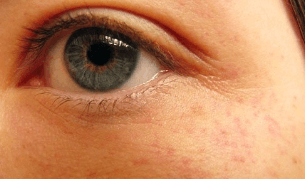 Red Dots Around The Eyes Causes and Treatment