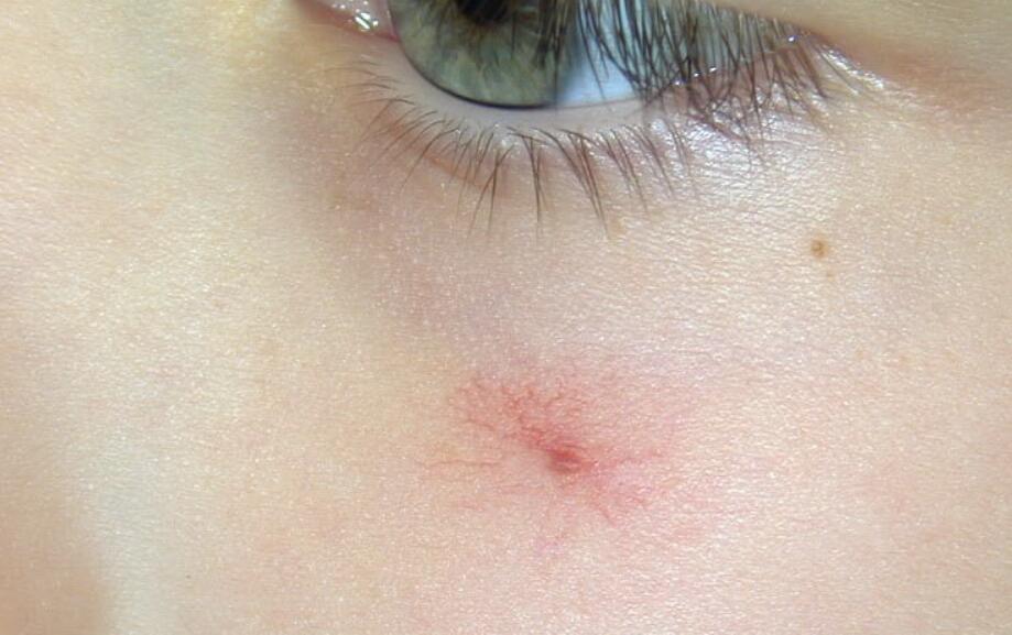 Small Red Dot Rash On Child S Face at Mary Cargile blog